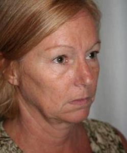 before facelift | neck lift female patient right angled view case 3646
