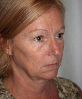 before facelift | neck lift female patient right angled view case 3646