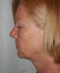 before facelift | neck lift female patient left side view case 3646