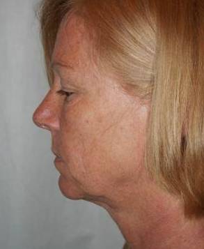before facelift | neck lift female patient left side view case 3646