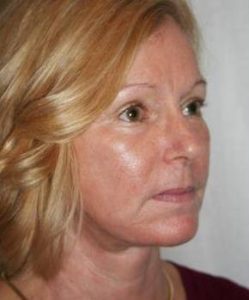 after facelift | neck lift female patient right angled view case 3646