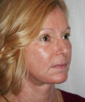 after facelift | neck lift female patient right angled view case 3646