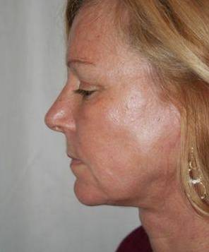 after facelift | neck lift female patient left side view case 3646