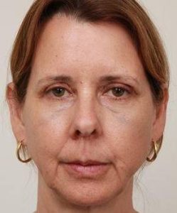 before facelift | neck lift female patient front view case 3651