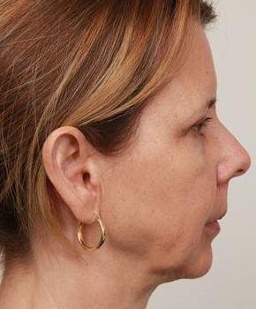 before facelift | neck lift female patient right side view case 3651