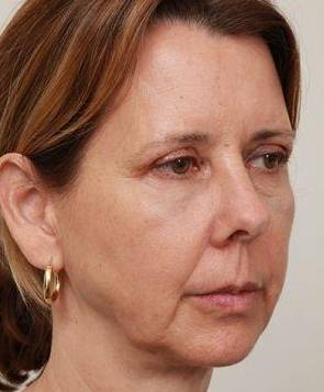 before facelift | neck lift female patient right angled view case 3651