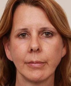 after facelift | neck lift female patient front view case 3651