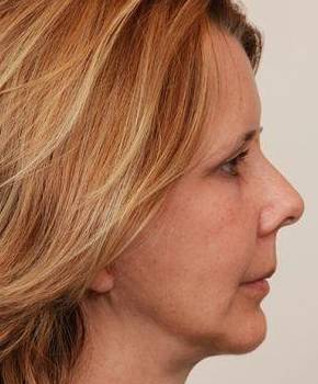 after facelift | neck lift female patient right side view case 3651