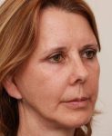 after facelift | neck lift female patient right angled view case 3651