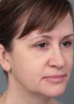 Before Facelift | Neck Lift Female Patient Diagonal Angle View Case 3658