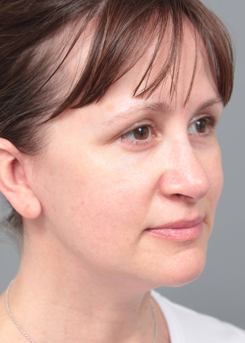 After Facelift | Neck Lift Female Patient Diagonal Angle View Case 3658