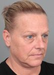 Before Facelift | Neck Lift Female Patient Diagonal Angle View Case 3514