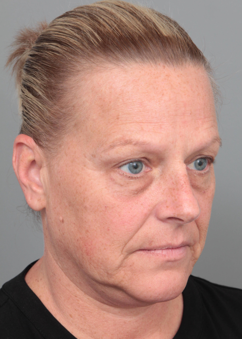 Before Facelift | Neck Lift Female Patient Diagonal Angle View Case 3514