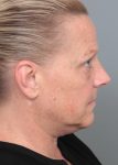 Before Facelift | Neck Lift Female Patient Side Angle View Case 3514