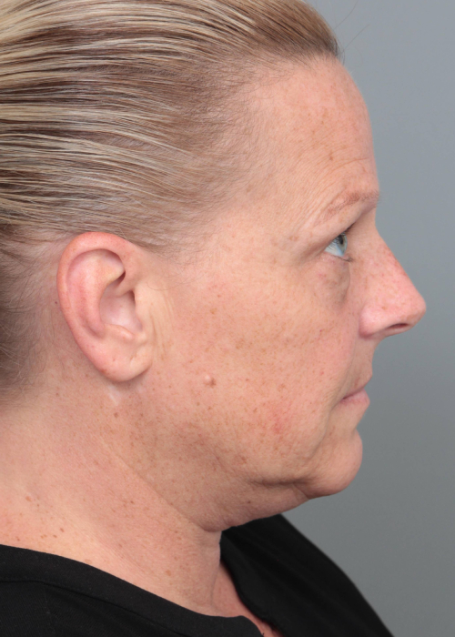 Before Facelift | Neck Lift Female Patient Side Angle View Case 3514