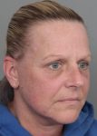 After Facelift | Neck Lift Female Patient Diagonal Angle View Case 3514
