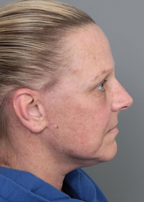After Facelift | Neck Lift Female Patient Side Angle View Case 3514