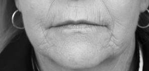 before laser skin resurfacing female patient front view case 2846