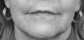 after laser skin resurfacing female patient front view case 2846