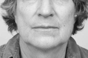 after laser skin resurfacing female patient front view case 2849