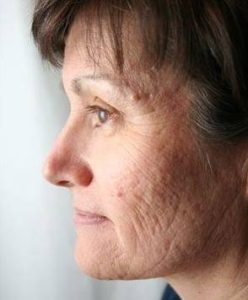 before laser skin resurfacing female patient left side view case 2852