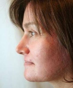 after laser skin resurfacing female patient left side view case 2852