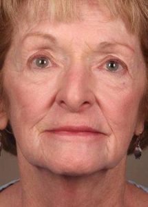 before laser skin resurfacing female patient front view case 2855
