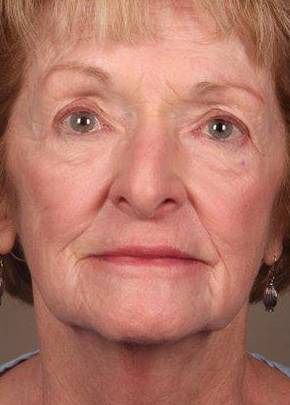 before laser skin resurfacing female patient front view case 2855