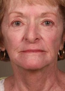 after laser skin resurfacing female patient front view case 2855