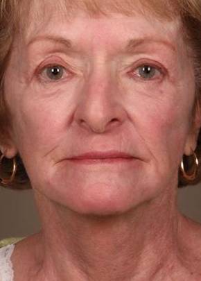 after laser skin resurfacing female patient front view case 2855