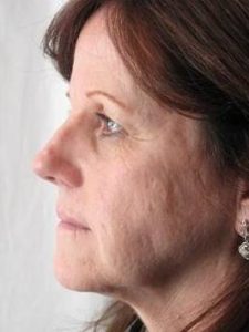 before laser skin resurfacing left side view female patient case 2858