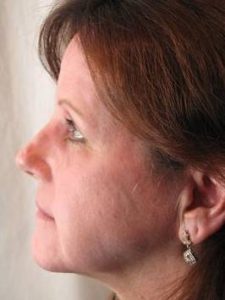 after laser skin resurfacing left side view female patient case 2858