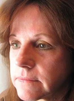 after laser skin resurfacing left angled view female patient case 2858