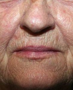 before laser skin resurfacing lower face view female patient case 2863