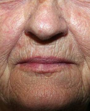 before laser skin resurfacing lower face view female patient case 2863