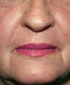 after laser skin resurfacing lower face view female patient case 2863