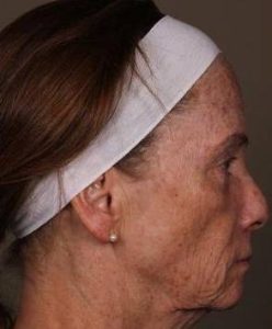 before laser skin resurfacing right side view female patient case 2866