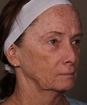 before laser skin resurfacing right angle view female patient case 2866