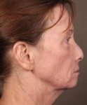 after laser skin resurfacing right side view female patient case 2866