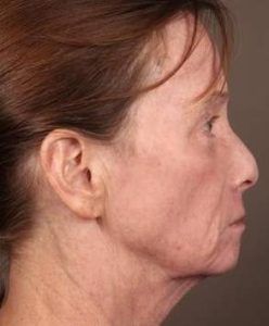 after laser skin resurfacing right side view female patient case 2866