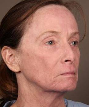 after laser skin resurfacing right angle view female patient case 2866