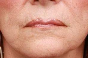 before laser skin resurfacing lower face view female patient case 2871