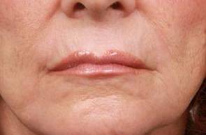 after laser skin resurfacing lower face view female patient case 2871