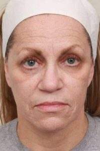 before laser skin resurfacing front view female patient case 2874