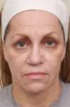before laser skin resurfacing front view female patient case 2874