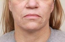 before laser skin resurfacing lower face view female patient case 2874