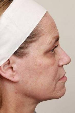 before laser skin resurfacing right side view female patient case 2874