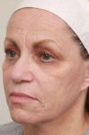 before laser skin resurfacing left angle view female patient case 2874
