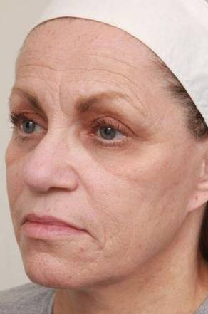 before laser skin resurfacing left angle view female patient case 2874