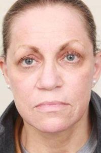 after laser skin resurfacing front view female patient case 2874